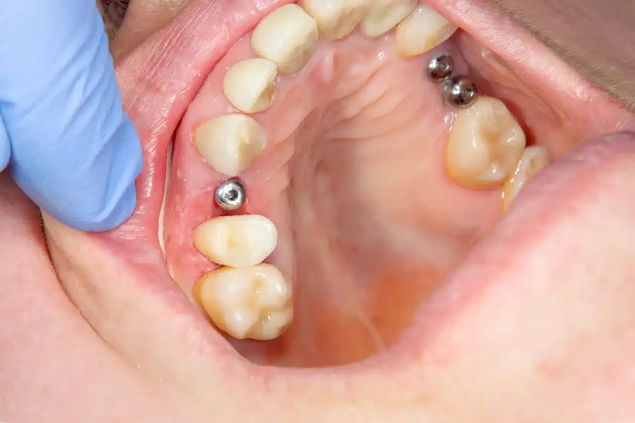 Patients Mouth With Screws Dental Implant