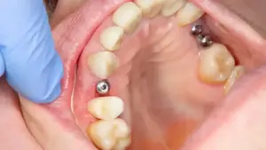 Everything you need to know before going for a Dental Implant | Port Pacific Dental Everything you need to know before going for a Dental Implant