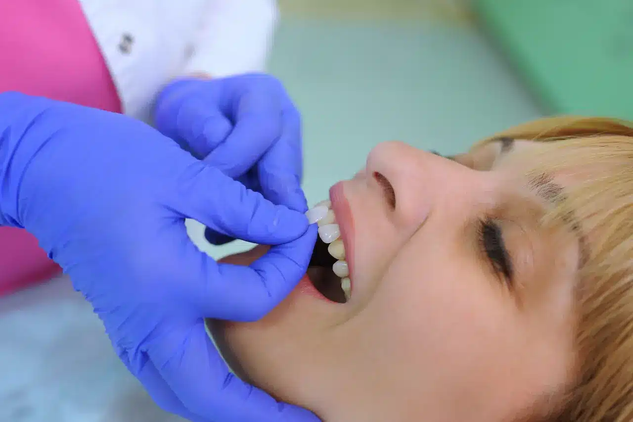 Dentist Puts Dental Veneers to Patient Veneers Are The Makeover
